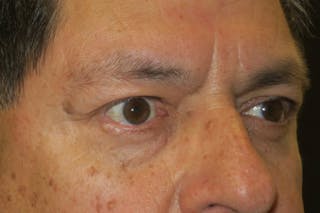 Mohs Reconstruction Before & After Gallery - Patient 369663 - Image 4