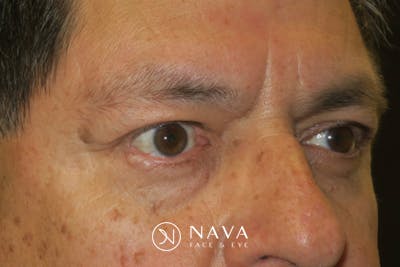 Mohs Reconstruction Before & After Gallery - Patient 369663 - Image 4