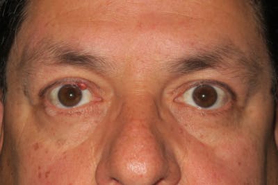 Mohs Reconstruction Before & After Gallery - Patient 369663 - Image 1