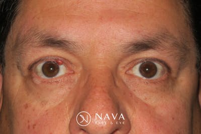 Mohs Reconstruction Before & After Gallery - Patient 369663 - Image 1