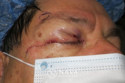 Mohs Reconstruction Before & After Gallery - Patient 369663 - Image 3