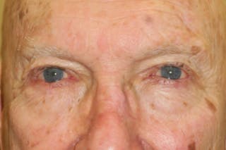 Mohs Reconstruction Before & After Gallery - Patient 667550 - Image 2