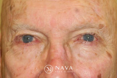 Mohs Reconstruction Before & After Gallery - Patient 667550 - Image 2