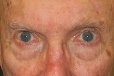 Mohs Reconstruction Before & After Gallery - Patient 667550 - Image 1