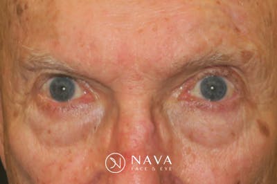 Mohs Reconstruction Before & After Gallery - Patient 667550 - Image 1