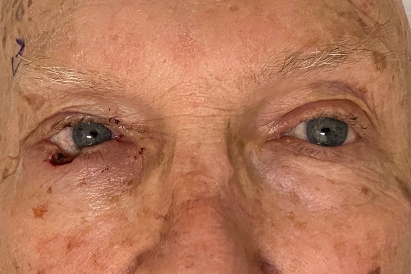 Mohs Reconstruction Before & After Gallery - Patient 667550 - Image 3