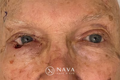 Mohs Reconstruction Before & After Gallery - Patient 667550 - Image 3