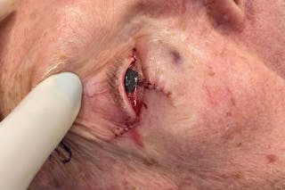 Mohs Reconstruction Before & After Gallery - Patient 667550 - Image 4