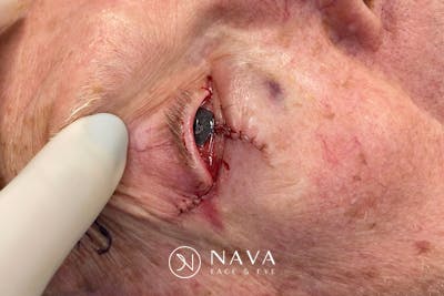 Mohs Reconstruction Before & After Gallery - Patient 667550 - Image 4