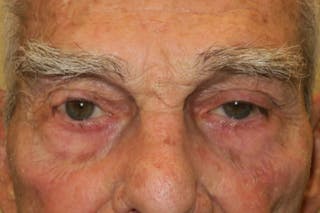 Mohs Reconstruction Before & After Gallery - Patient 400342 - Image 2
