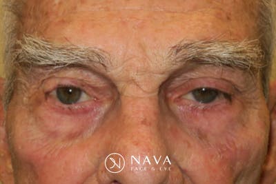 Mohs Reconstruction Before & After Gallery - Patient 400342 - Image 2