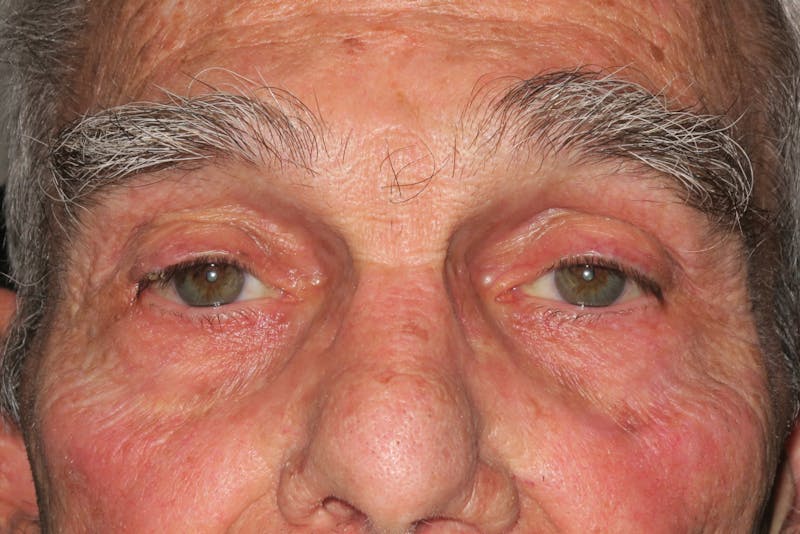 Mohs Reconstruction Before & After Gallery - Patient 400342 - Image 1
