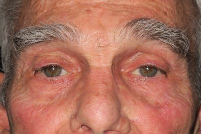 Mohs Reconstruction Before & After Gallery - Patient 400342 - Image 1