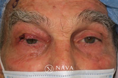 Mohs Reconstruction Before & After Gallery - Patient 400342 - Image 3