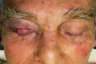 Mohs Reconstruction Before & After Gallery - Patient 400342 - Image 4