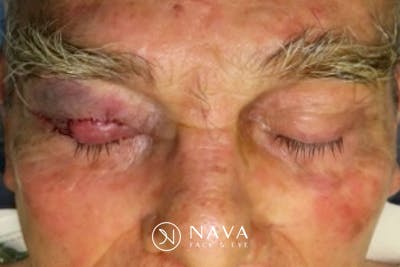 Mohs Reconstruction Before & After Gallery - Patient 400342 - Image 4