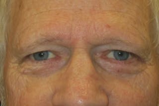 Mohs Reconstruction Before & After Gallery - Patient 307696 - Image 2