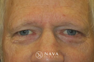 Mohs Reconstruction Before & After Gallery - Patient 307696 - Image 2