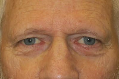 Mohs Reconstruction Before & After Gallery - Patient 307696 - Image 1