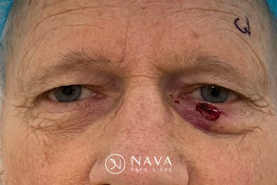 Mohs Reconstruction Before & After Gallery - Patient 307696 - Image 3