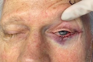 Mohs Reconstruction Before & After Gallery - Patient 307696 - Image 4