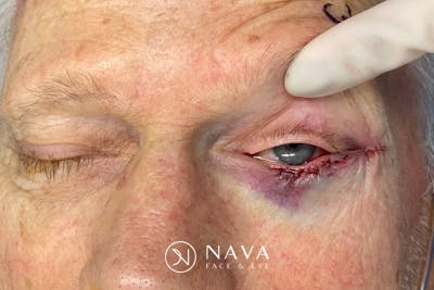 Mohs Reconstruction Before & After Gallery - Patient 307696 - Image 4