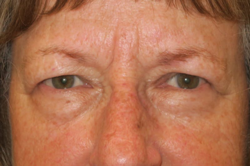 Mohs Reconstruction Before & After Gallery - Patient 289359 - Image 1