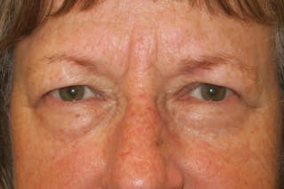 Mohs Reconstruction Before & After Gallery - Patient 289359 - Image 2