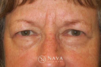 Mohs Reconstruction Before & After Gallery - Patient 289359 - Image 2