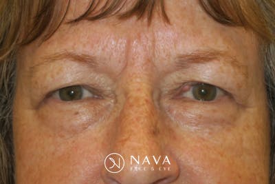 Mohs Reconstruction Before & After Gallery - Patient 289359 - Image 1