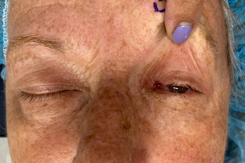 Mohs Reconstruction Before & After Gallery - Patient 289359 - Image 3