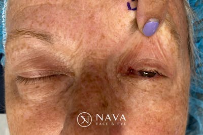 Mohs Reconstruction Before & After Gallery - Patient 289359 - Image 3