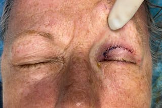 Mohs Reconstruction Before & After Gallery - Patient 289359 - Image 4