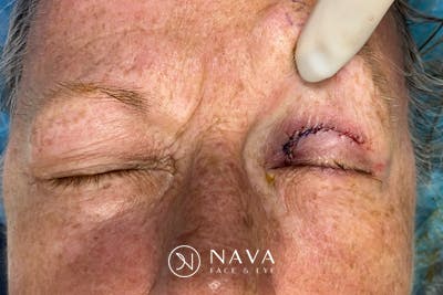 Mohs Reconstruction Before & After Gallery - Patient 289359 - Image 4