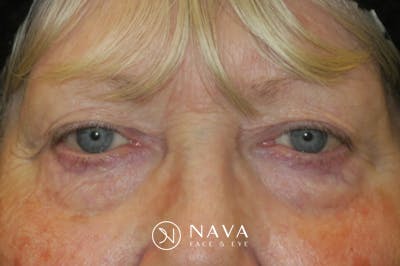 Ptosis Repair Before & After Gallery - Patient 865085 - Image 2