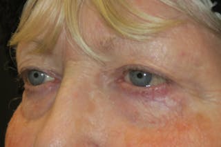 Ptosis Repair Before & After Gallery - Patient 865085 - Image 4