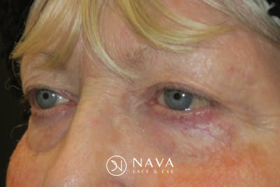 Ptosis Repair Before & After Gallery - Patient 865085 - Image 4