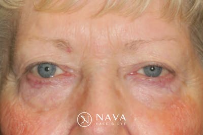 Ptosis Repair Before & After Gallery - Patient 865085 - Image 1