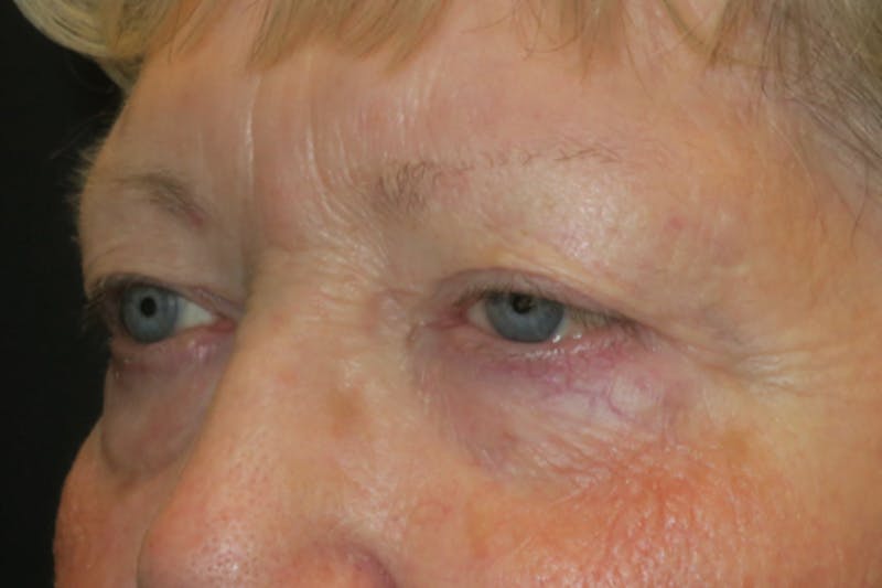 Ptosis Repair Before & After Gallery - Patient 865085 - Image 3