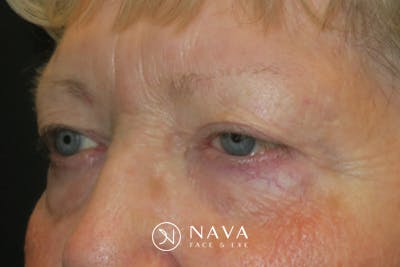 Ptosis Repair Before & After Gallery - Patient 865085 - Image 3