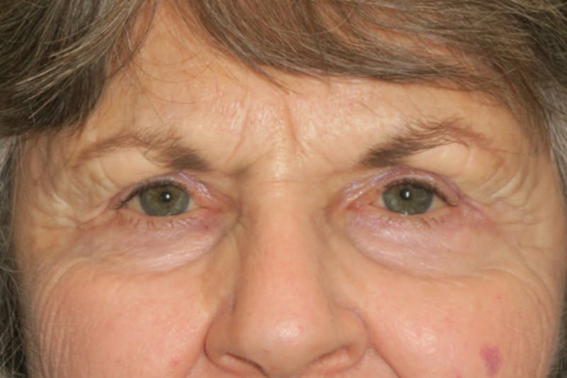 Upper Blepharoplasty (Upper Eyelid Surgery) Before & After Gallery - Patient 182822 - Image 2