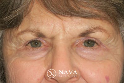 Upper Blepharoplasty (Upper Eyelid Surgery) Before & After Gallery - Patient 182822 - Image 2