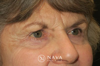 Upper Blepharoplasty (Upper Eyelid Surgery) Before & After Gallery - Patient 182822 - Image 4