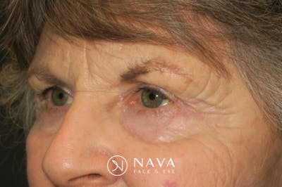Upper Blepharoplasty (Upper Eyelid Surgery) Before & After Gallery - Patient 182822 - Image 6