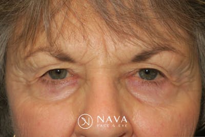 Upper Blepharoplasty (Upper Eyelid Surgery) Before & After Gallery - Patient 182822 - Image 1
