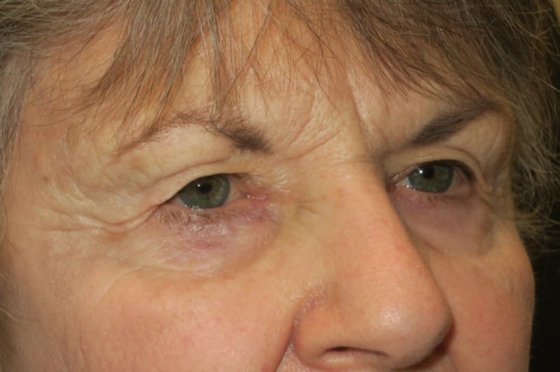 Upper Blepharoplasty (Upper Eyelid Surgery) Before & After Gallery - Patient 182822 - Image 3