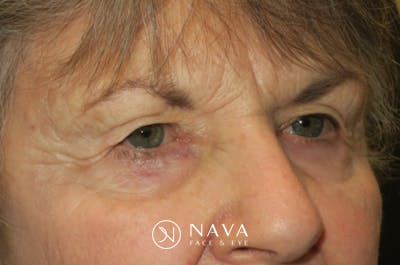 Upper Blepharoplasty (Upper Eyelid Surgery) Before & After Gallery - Patient 182822 - Image 3