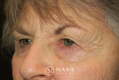 Upper Blepharoplasty (Upper Eyelid Surgery) Before & After Gallery - Patient 182822 - Image 5