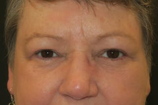 Upper Blepharoplasty (Upper Eyelid Surgery) Before & After Gallery - Patient 400208 - Image 2