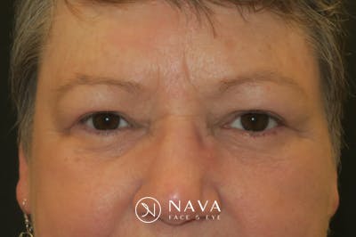 Upper Blepharoplasty (Upper Eyelid Surgery) Before & After Gallery - Patient 400208 - Image 2